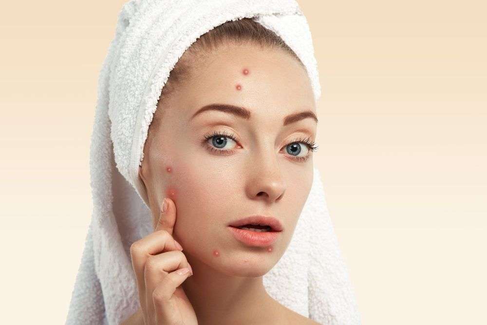 <a href="https://www.freepik.com/free-photo/closeup-young-woman-with-towel-head-pimples-face_10322203.htm#query=pimples&position=11&from_view=search&track=sph">Image by wayhomestudio</a> on Freepik 