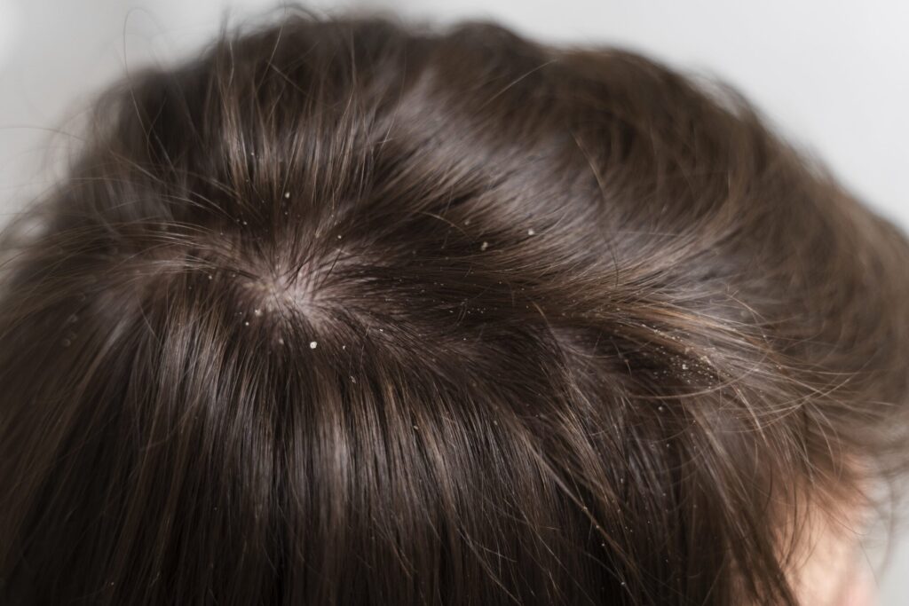 How to get rid of dandruff?